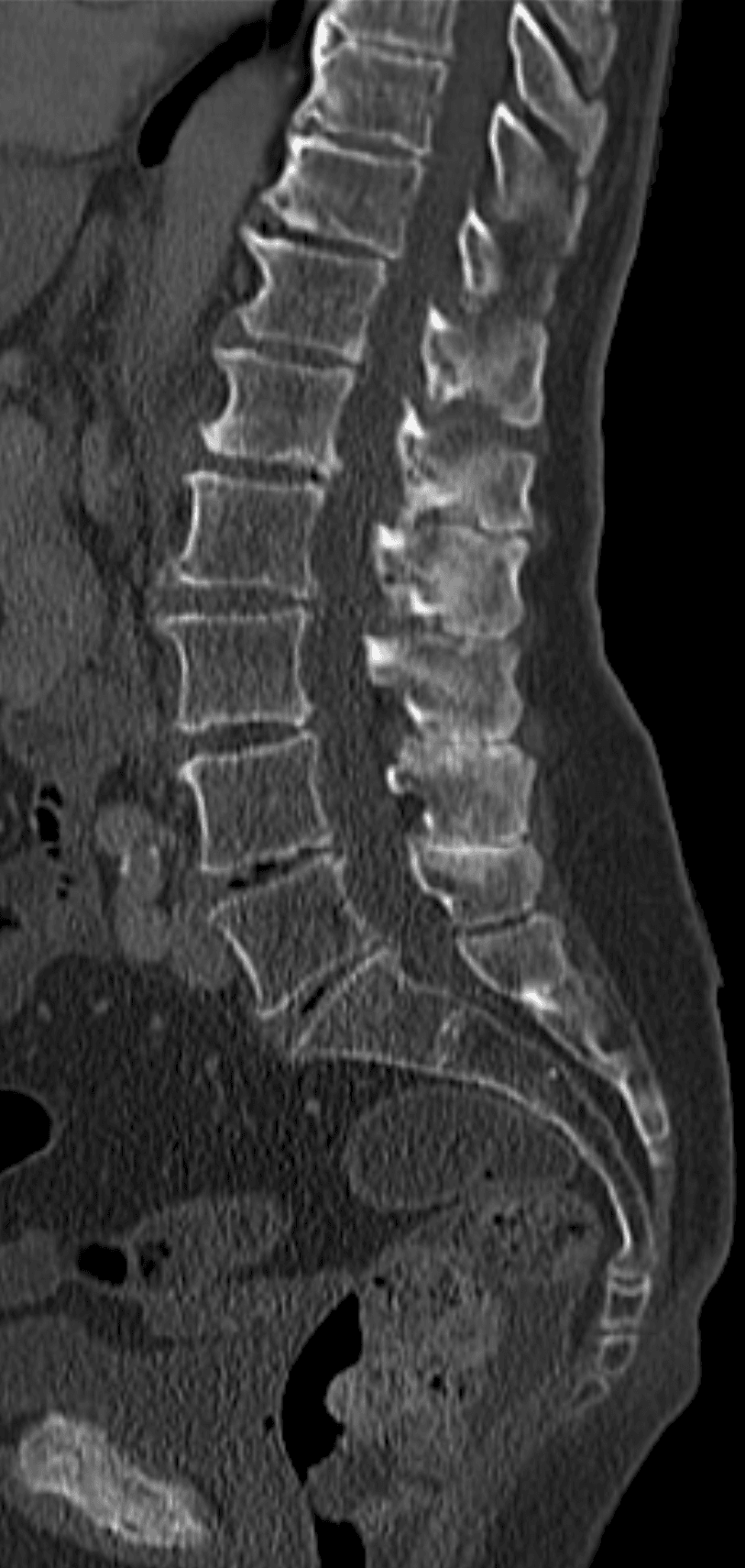 Sagittal CT of lumbar spine showing Baastrup disease