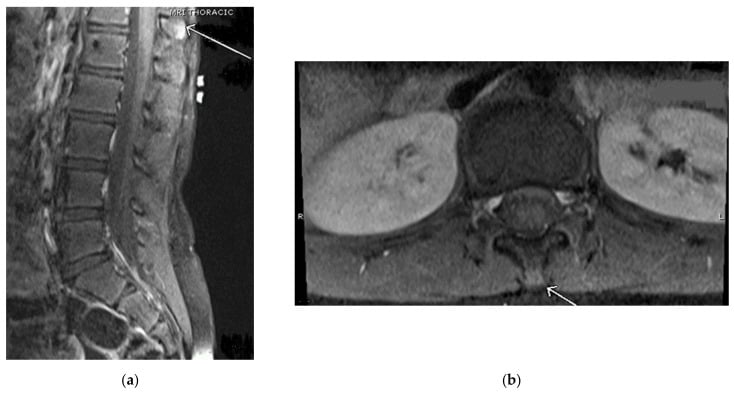 Sagittal T2 lumbar MRI demonstrating interspinous bursitis and kissing spines in Baastrup's disease