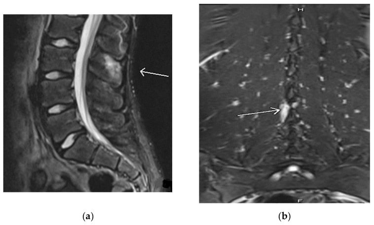 Sagittal STIR MRI showing interspinous fluid accumulation and spinous process marrow edema