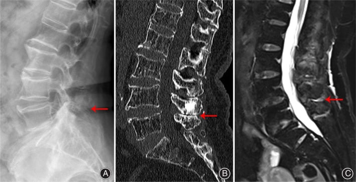 Endoscopic views demonstrating interspinous decompression and spinous process resection in Baastrup's disease