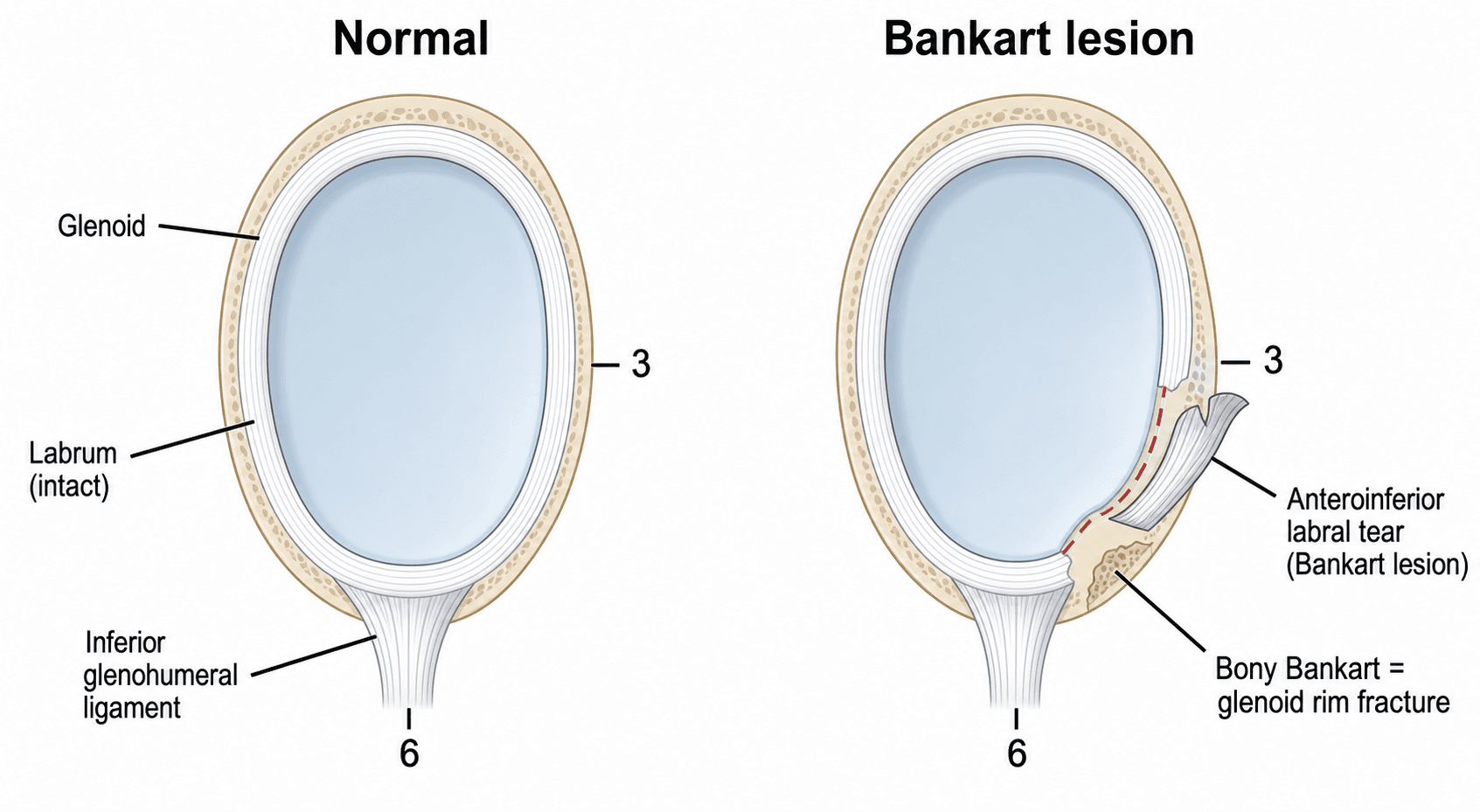 Diagram comparing a normal glenoid labrum with a Bankart lesion.