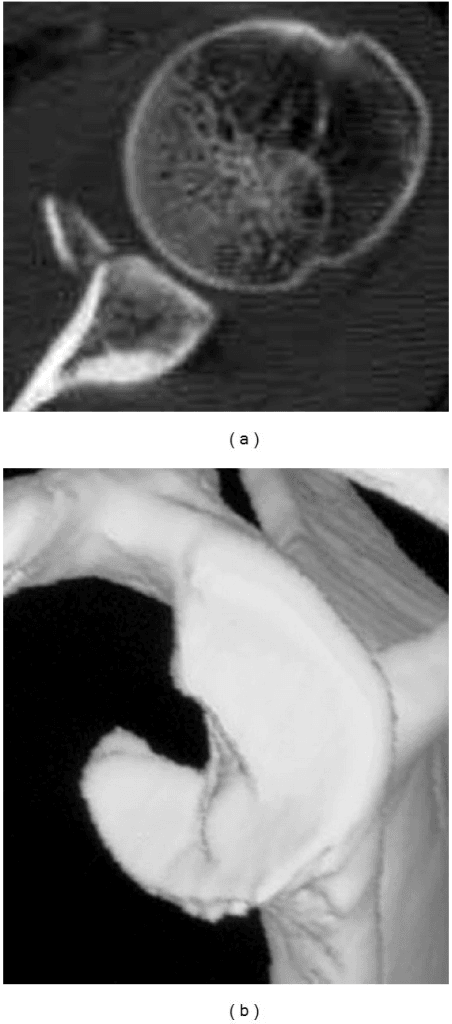 Axial CT showing a bony Bankart lesion at the anteroinferior glenoid