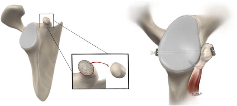 Diagram of coracoid transfer fixed to the anterior scapular neck