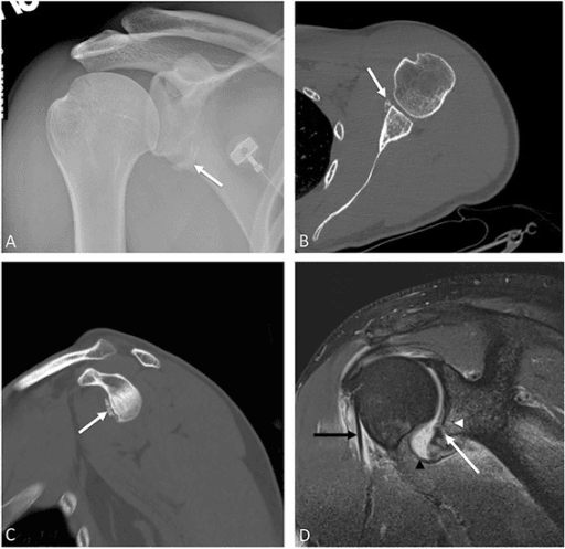 Radiograph, CT and MRI of bony Bankart lesions in several patients