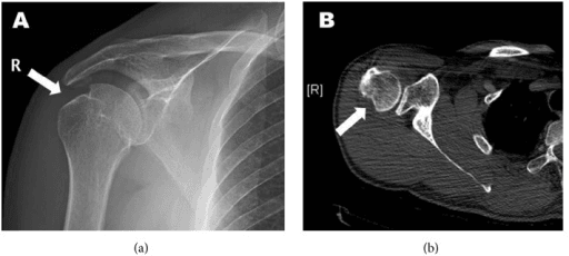 Radiograph and CT showing a Hill-Sachs lesion of the posterosuperior humeral head