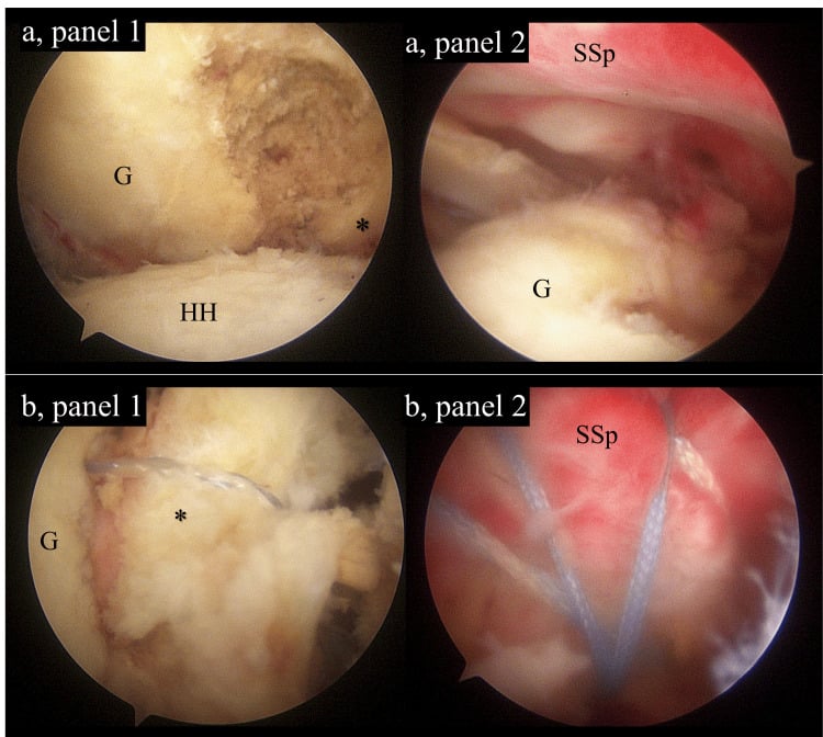 Arthroscopic images of a bony Bankart lesion before and after repair