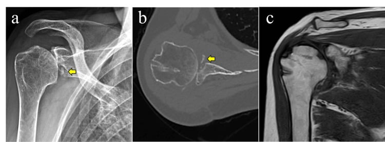 Radiograph, CT and MRI showing glenoid fragment nonunion at one year