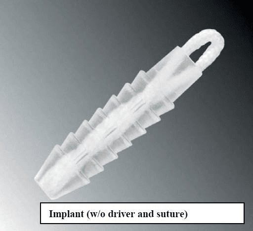 Photograph of the suture anchor used for Bankart repair