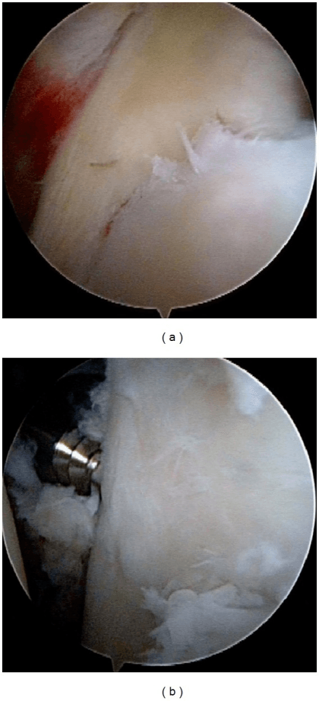 Arthroscopic view of a bony Bankart fragment reduced with a grasper