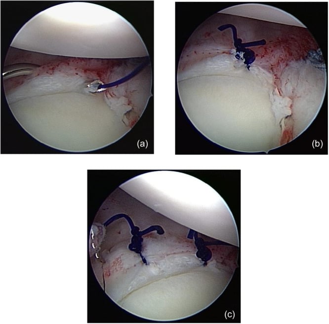 Arthroscopic images of suture-only capsular plication