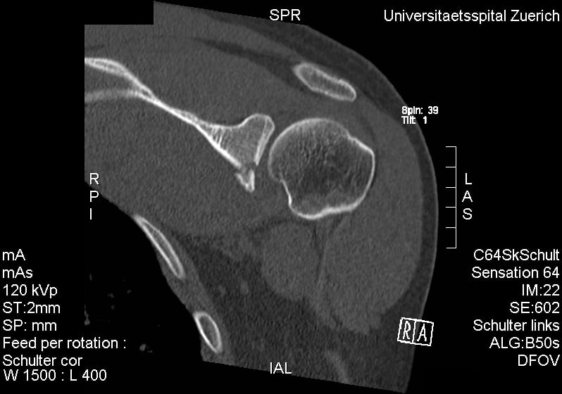 Axial CT of the shoulder showing a bony Bankart lesion at the anteroinferior glenoid.