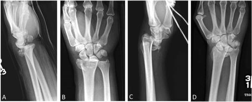 Comparison of dorsal Barton's and volar Barton's (reverse Barton's) fractures on radiographs