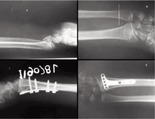 Pre-operative and post-operative radiographs of volar Barton's fracture with volar plate fixation