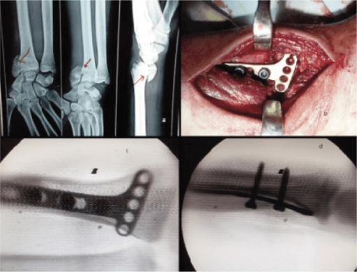 Volar Barton's fracture surgical technique with intraoperative photo