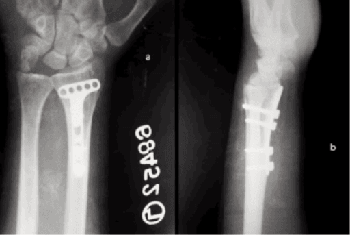 Final follow-up radiographs showing healed volar Barton's fracture