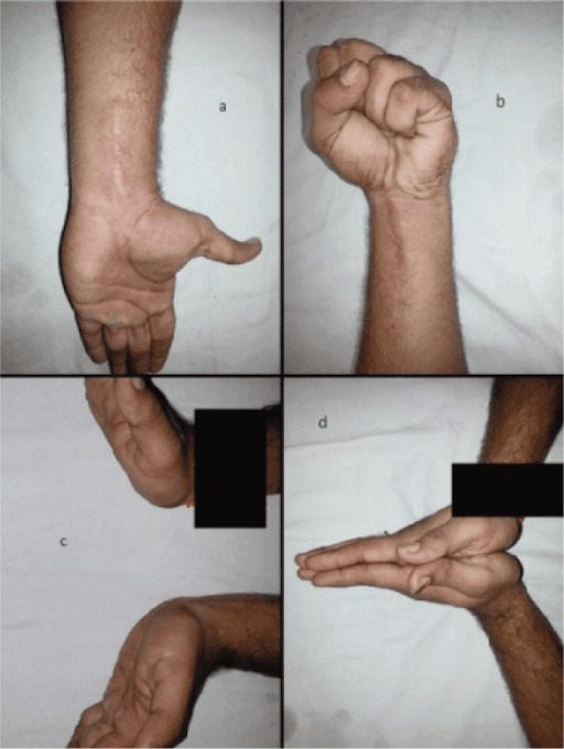 Clinical photographs demonstrating excellent functional outcome after Barton's fracture