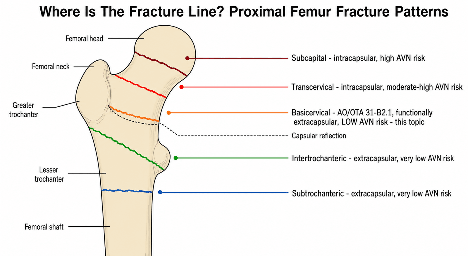Schematic diagram showing the location of subcapital, transcervical, basicervical, intertrochanteric and subtrochanteric fracture lines on the proximal femur relative to the capsular reflection