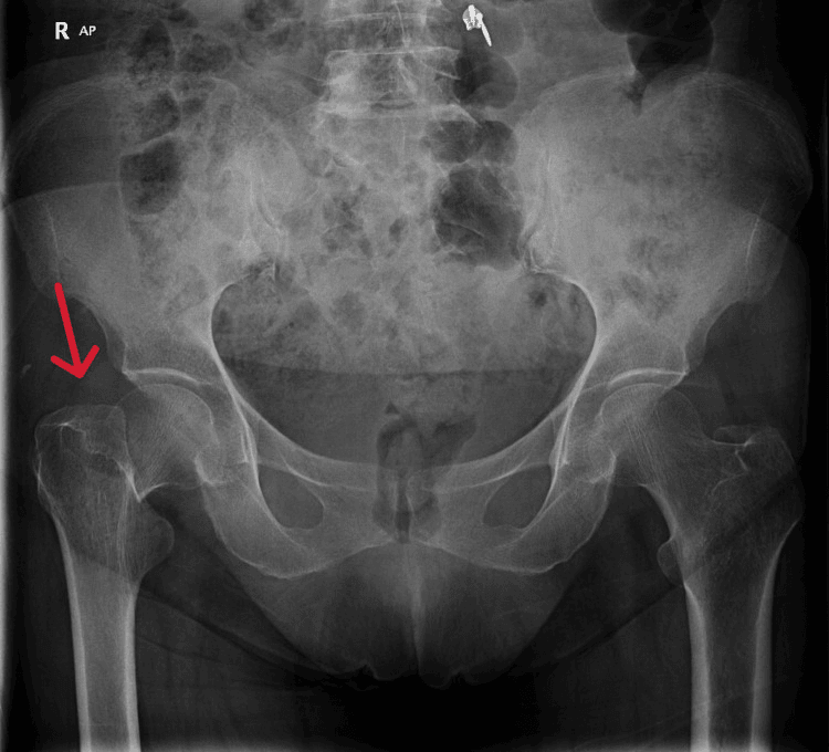AP pelvis radiograph with arrow marking a displaced right basicervical femoral-neck fracture