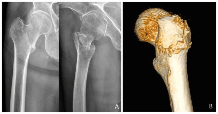 Basicervical fracture radiographs and three-dimensional CT showing occult greater-trochanter comminution
