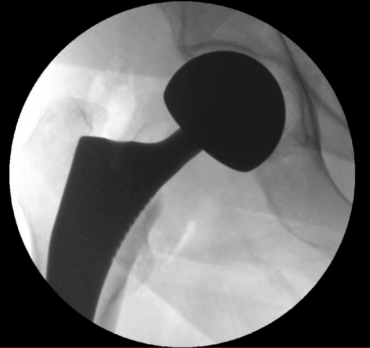 AP fluoroscopic image of bipolar hemiarthroplasty performed for a basicervical fracture