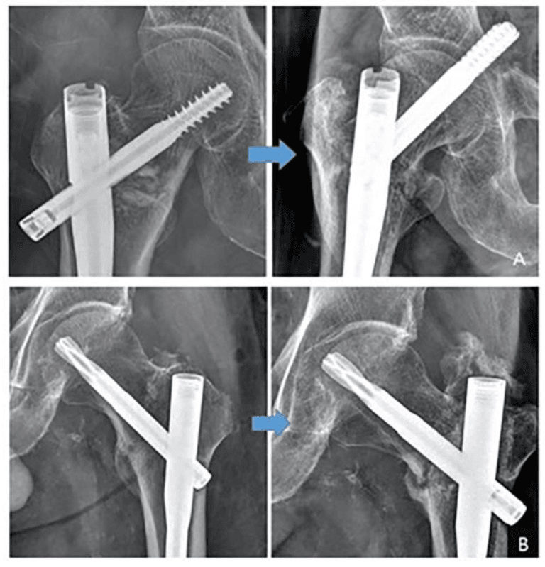 Paired radiographs showing cephalomedullary nail cut-out and rotational nonunion after basicervical fracture fixation