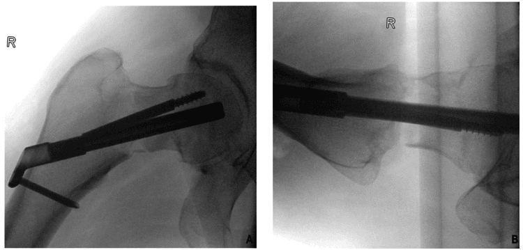 AP and lateral fluoroscopic images of dynamic hip-screw fixation across a basicervical fracture