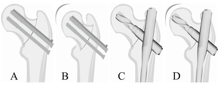 Four-panel schematic comparing cancellous-screw and cephalomedullary fixation with collapse patterns
