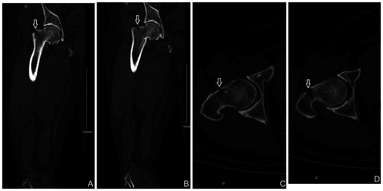 Coronal and axial hip CT images with arrows marking an occult basicervical femoral-neck fracture