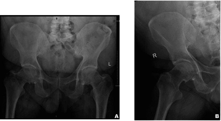 Initial AP pelvis radiograph and a second projection of the right hip, neither showing a visible fracture line