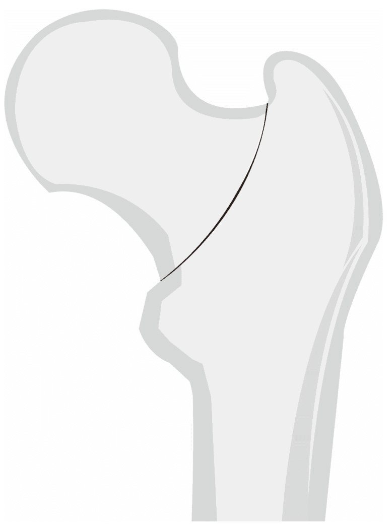 Schematic proximal femur showing one published radiographic definition of a basicervical fracture line