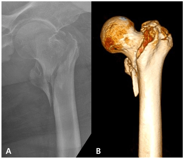 AP hip radiograph and three-dimensional CT showing an unstable basicervical fracture
