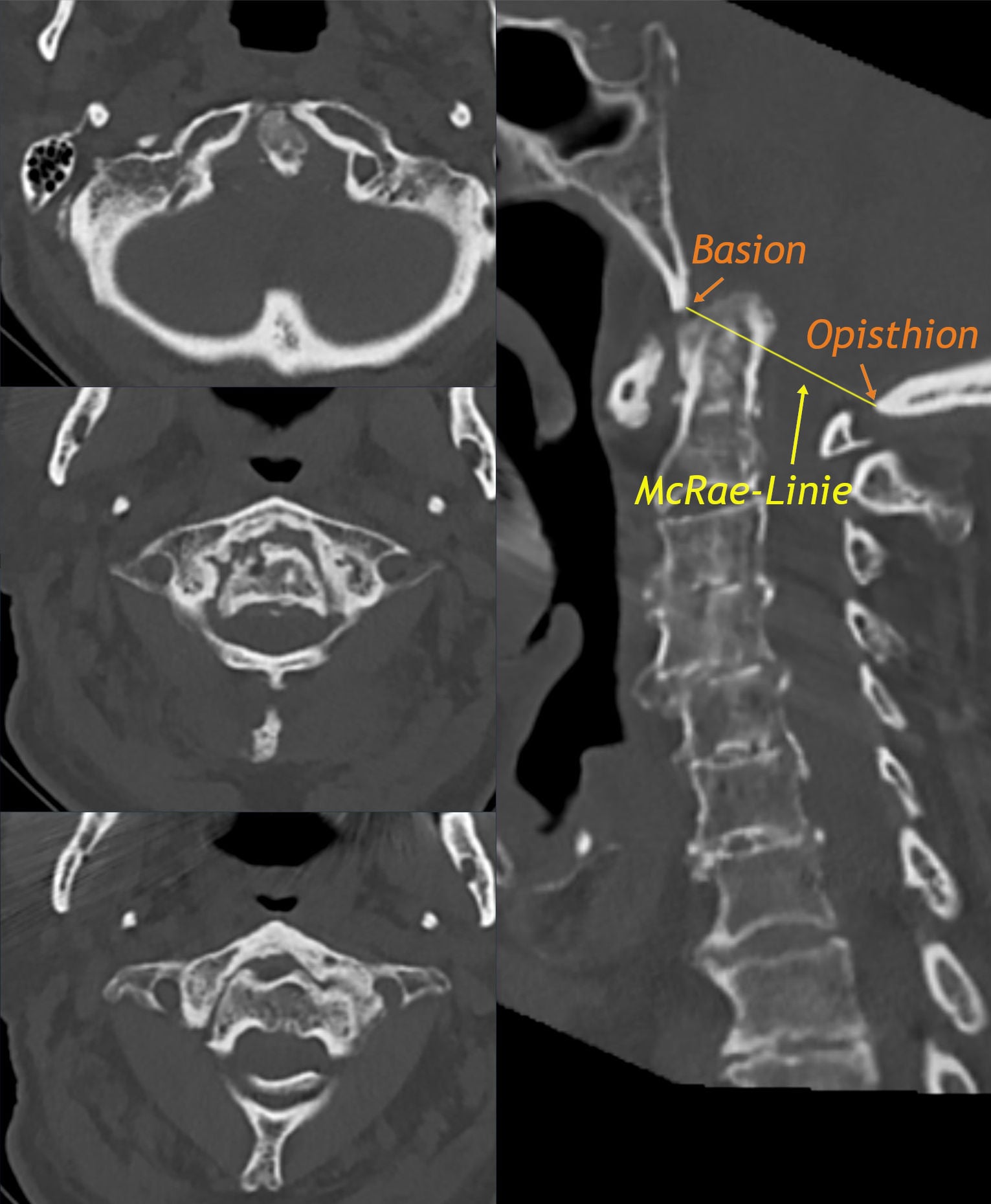 CT of the craniovertebral junction with the McRae line drawn from basion to opisthion, plus axial slices through the foramen magnum and atlantoaxial region.