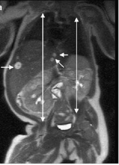 Coronal T2 MRI of a newborn with Beckwith-Wiedemann syndrome showing right hemihypertrophy and multiple hepatic hemangiomas