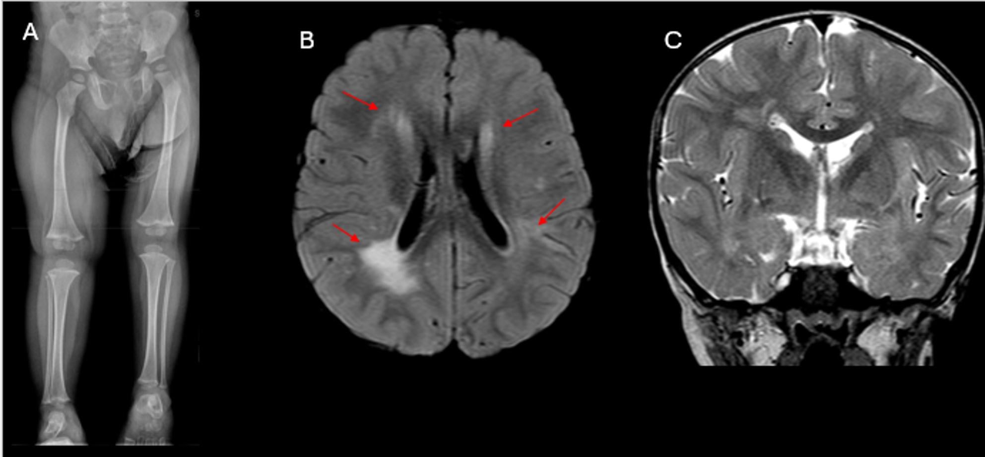 Full-length leg radiograph and brain MRI showing right-sided lateralised overgrowth in Beckwith-Wiedemann syndrome