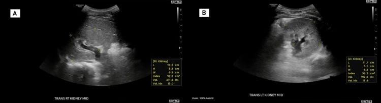 Bilateral renal ultrasound screening in a patient with isolated lateralised overgrowth