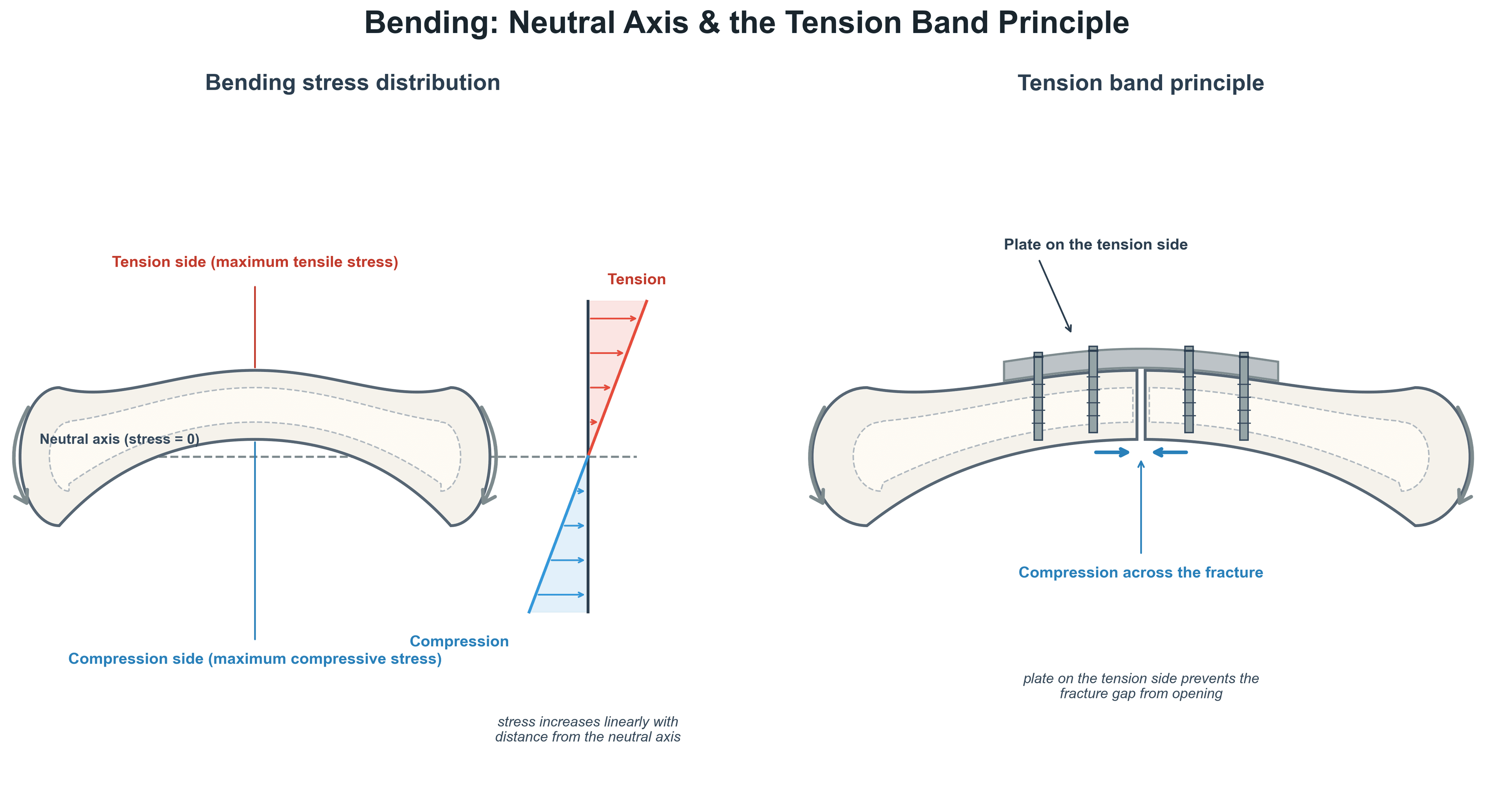 Diagram of bending stress distribution about the neutral axis and the tension band plating principle