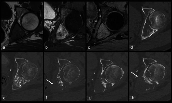 MRI and CT of a benign fibrous histiocytoma of bone in the acetabulum showing a well-defined osteolytic lesion with a sclerotic rim