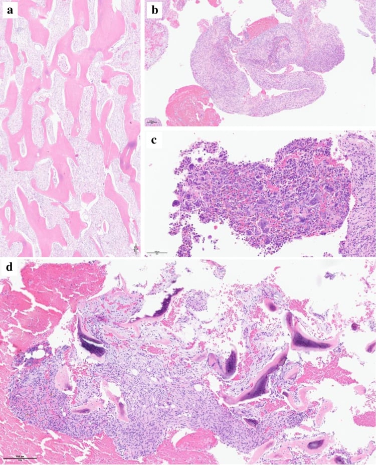 Histopathological H&E section demonstrating osteoid metaplasia in benign fibrous histiocytoma of bone