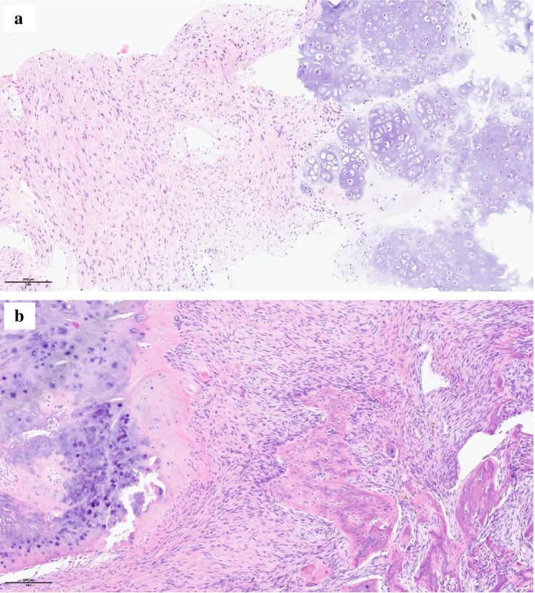 Histopathological H&E section demonstrating chondroid metaplasia in benign fibrous histiocytoma of bone