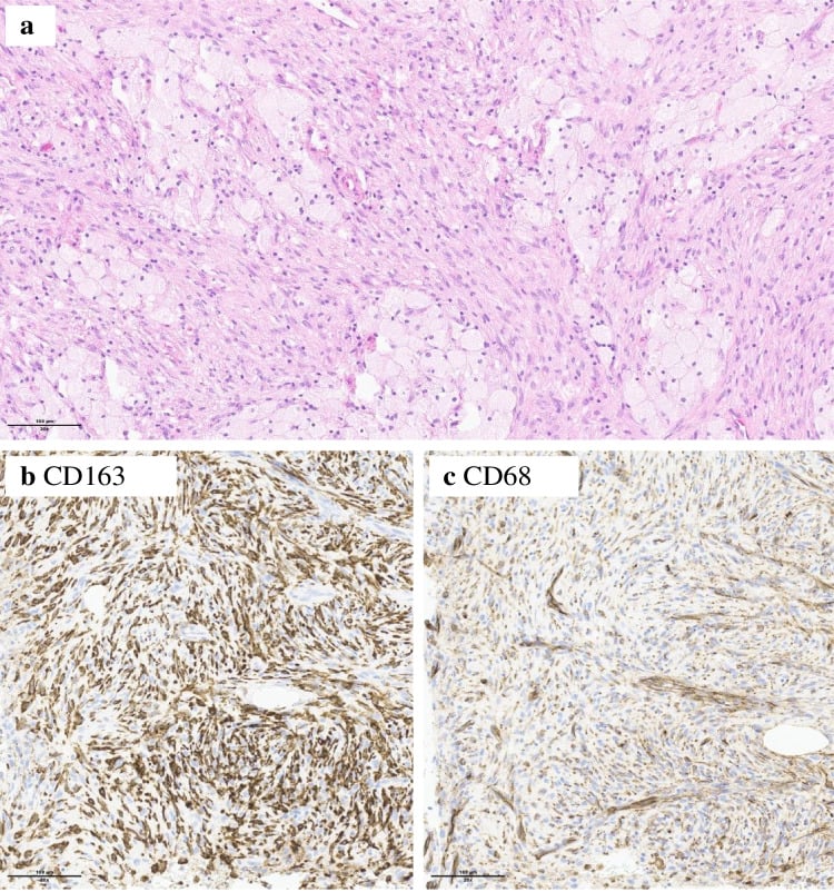 Histology of benign fibrous histiocytoma of bone showing spindle cells and foamy macrophages with CD163 and CD68 immunostaining