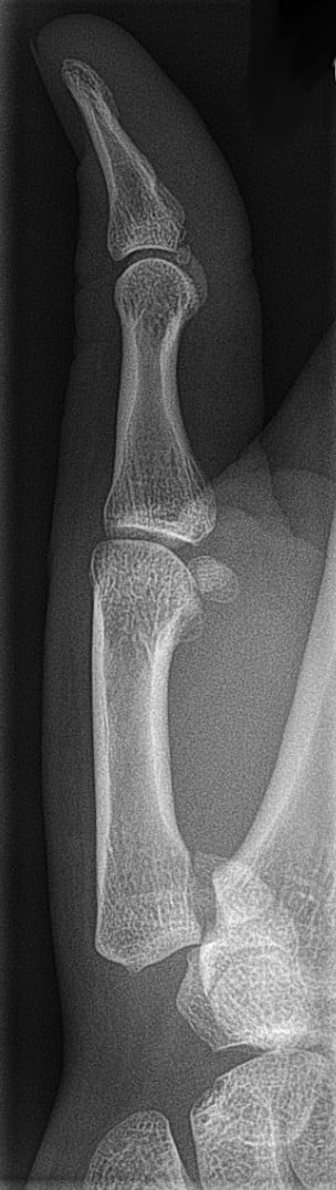 True-lateral radiograph of a Bennett fracture showing dorsal subluxation of the thumb metacarpal shaft at the CMC.