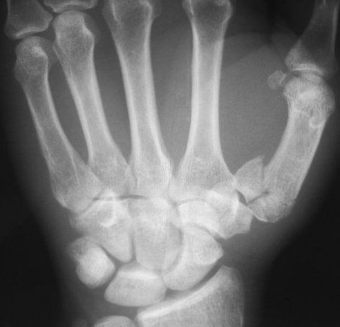Radiograph of a comminuted intra-articular Y-pattern fracture of the thumb metacarpal base (Rolando fracture).
