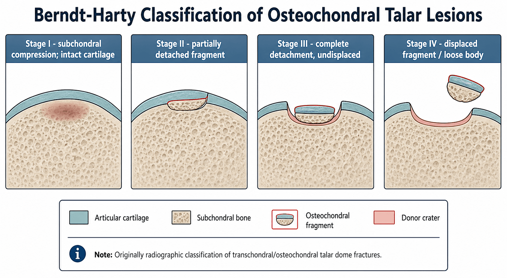 Berndt-Harty staging of osteochondral talar lesions: I compression, II partial detachment, III complete undisplaced, IV displaced loose body