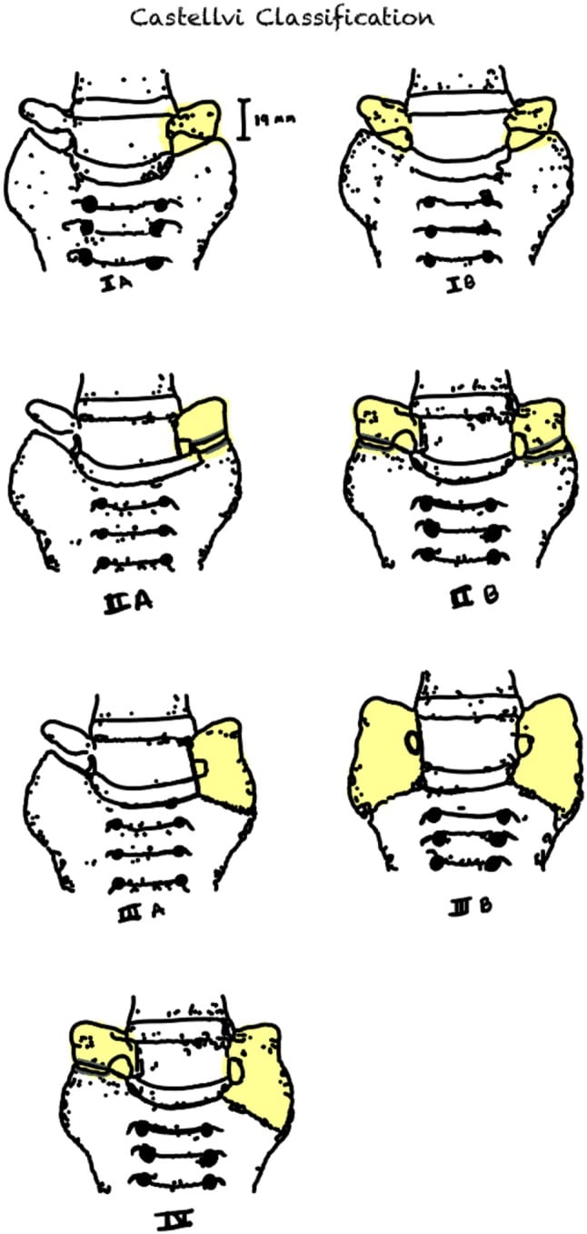 Castellvi classification drawings of lumbosacral transitional vertebrae, panels IA, IB, IIA, IIB, IIIA, IIIB and IV