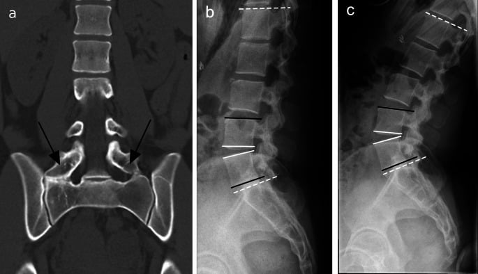Castellvi IIb LSTV on coronal CT with flexion and extension radiographs marked for segmental angle measurement