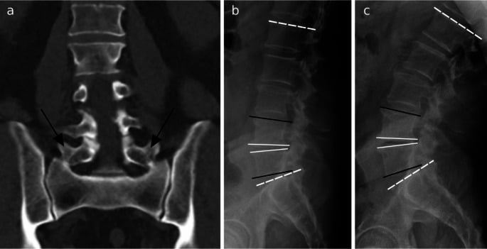 Second Castellvi IIb LSTV on coronal CT with flexion and extension radiographs marked for segmental angle measurement