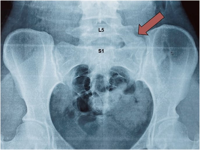 Ferguson radiograph with L5 and S1 labelled and an arrow on an overgrown left L5 transverse process fused to the sacral ala