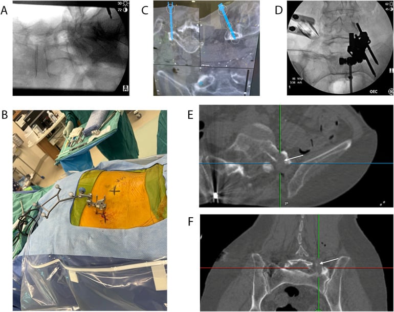 Fluoroscopy, navigation and intraoperative CT during a navigated minimally invasive transverse-process resection