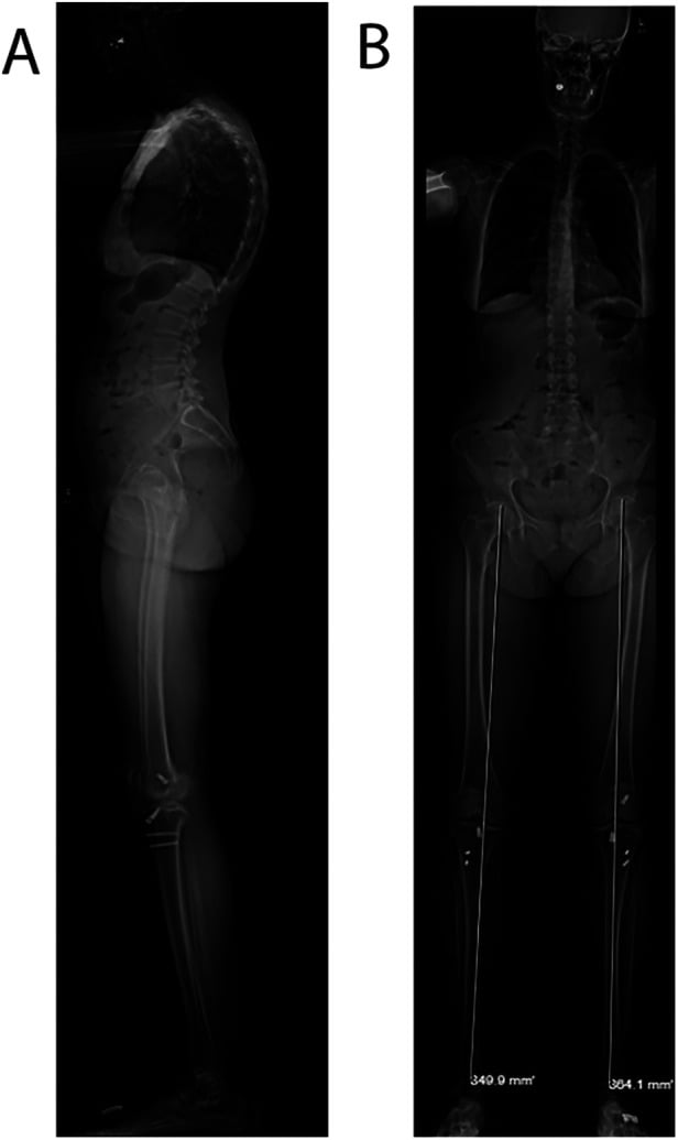 Standing EOS lateral and anteroposterior whole-body images from skull to feet