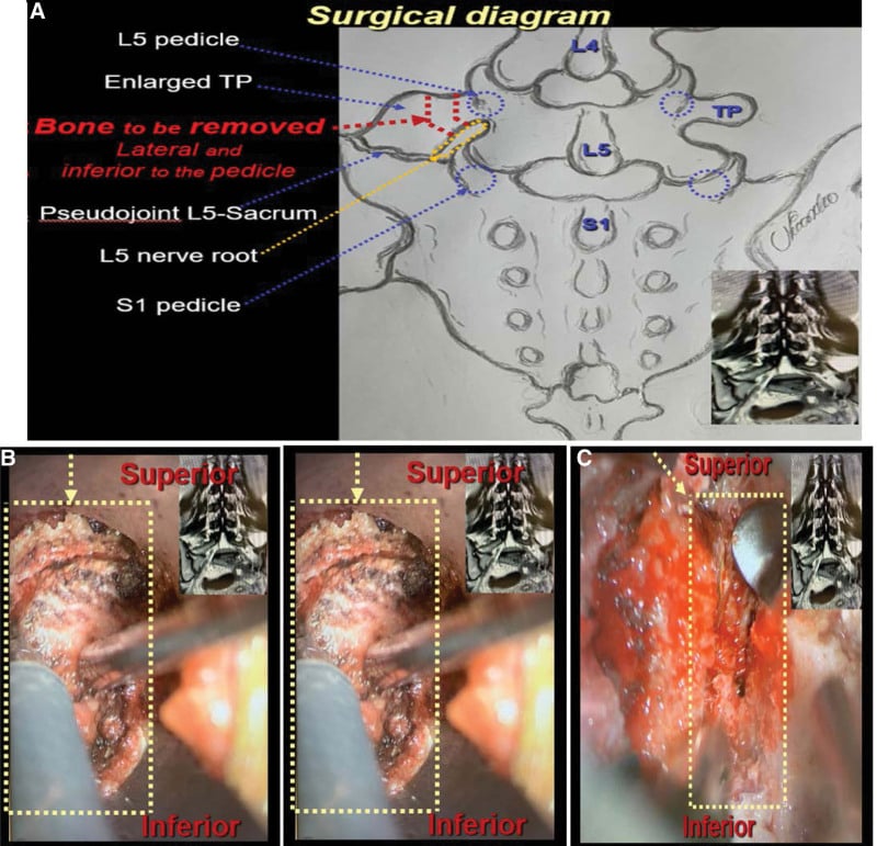Surgical diagram of a modified transverse processectomy with intraoperative microscope views of the resection